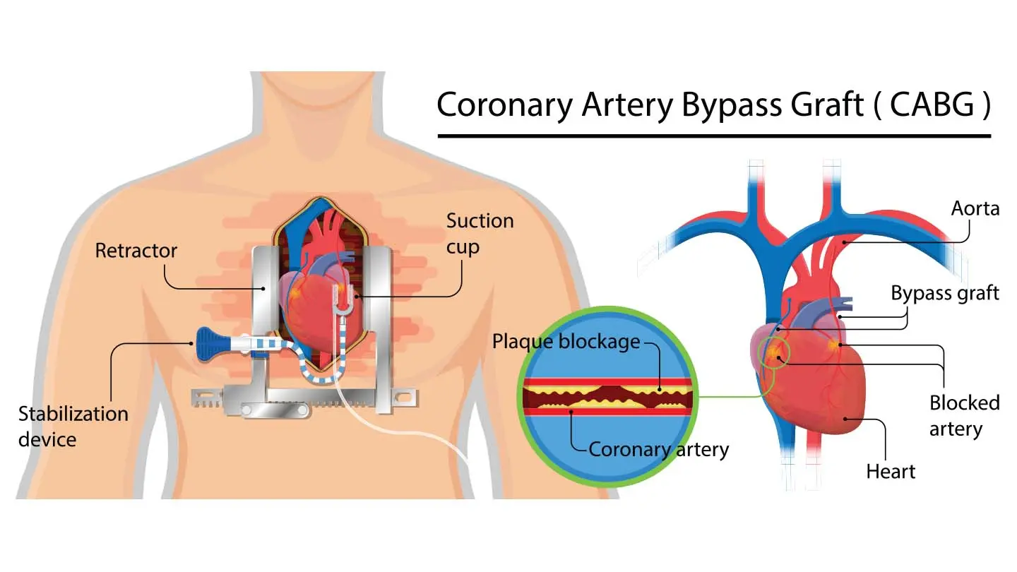 Coronary Artery Bypass